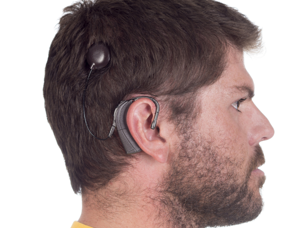 5 Key Questions About Cochlear Implants Answered My Hearing Guide